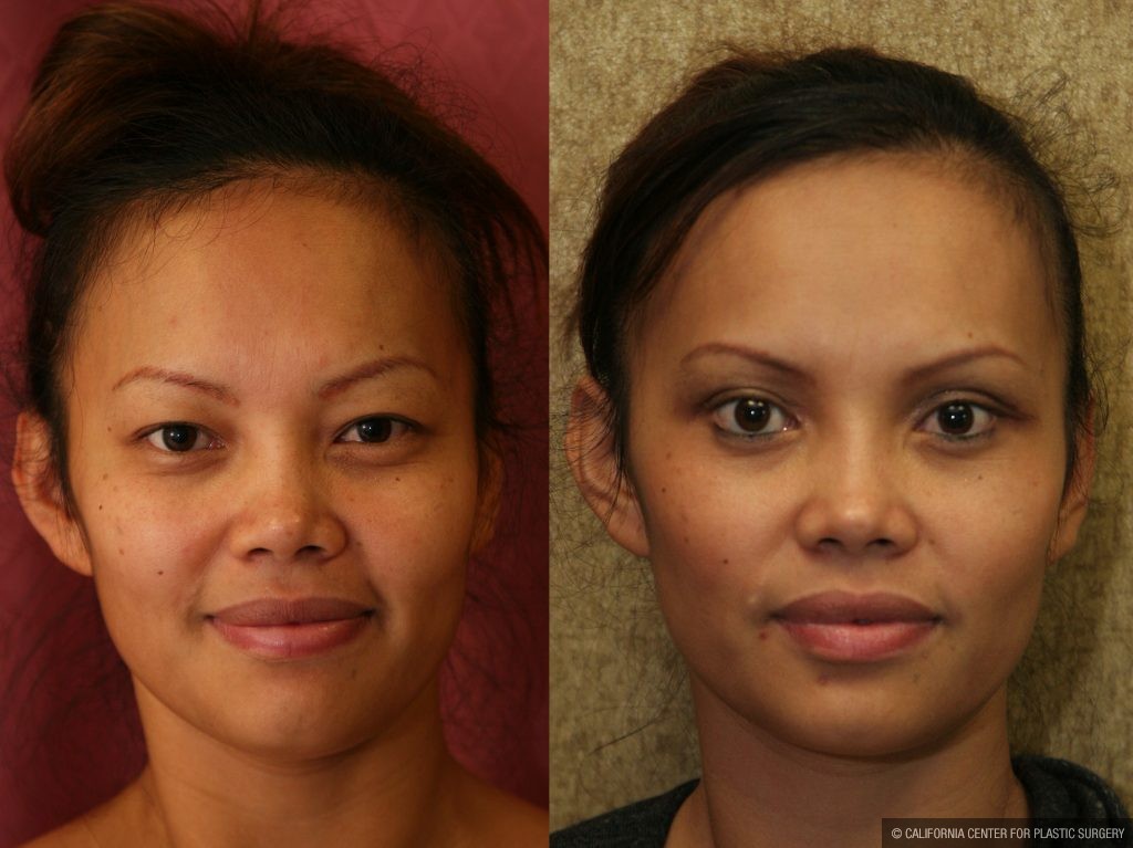 Asian women eye surgery